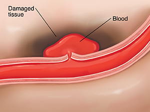 Cross section of ruptured artery in brain causing stroke.