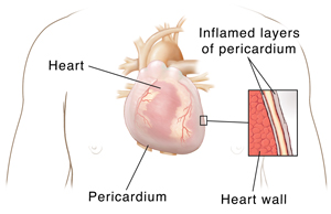 Front view of male chest showing heart and lungs with inset showing pericardium.