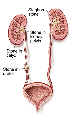 symptoms of a kidney infection