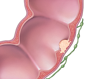 Cross section of colon and lymph nodes showing cancer spreading through wall of colon but not to lymph nodes.