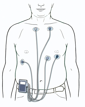 Torso de un hombre que muestra cinco cables de electrocardiograma conectados al pecho y a un monitor Holter sujeto al cinturón.