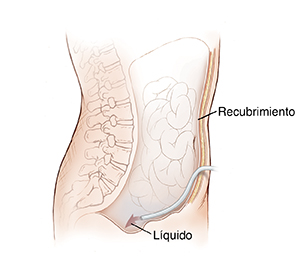 Vista lateral del abdomen donde puede verse un catéter insertado a través de la pared del cuerpo hacia el interior de la cavidad abdominal.