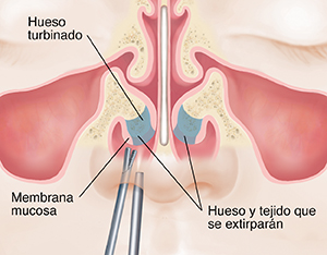 Vista frontal de una cara donde pueden verse instrumentos quirúrgicos que extirpan parte del hueso turbinado de la nariz.